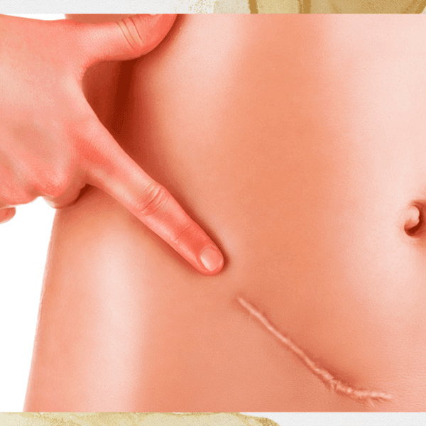 Cicatrices Inestéticas