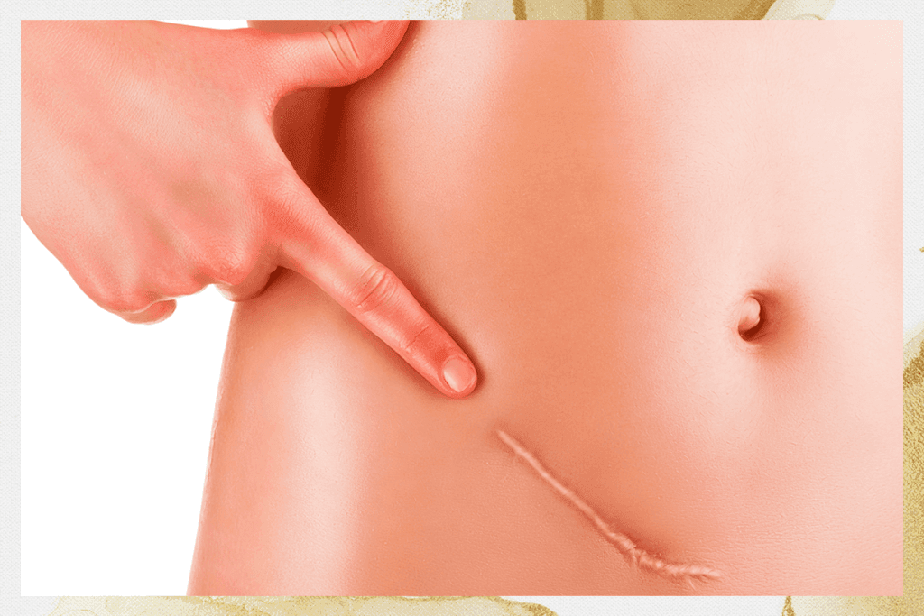 cicatrices inesteticas