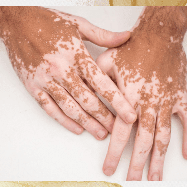 Vitiligo